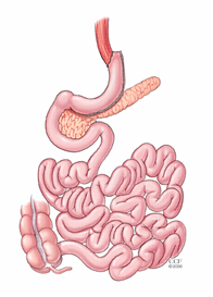 Sleeve Gastrectomy Diagram