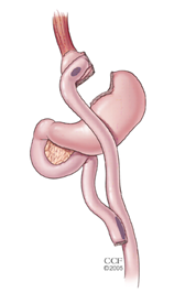 Gastric Bypass Diagram