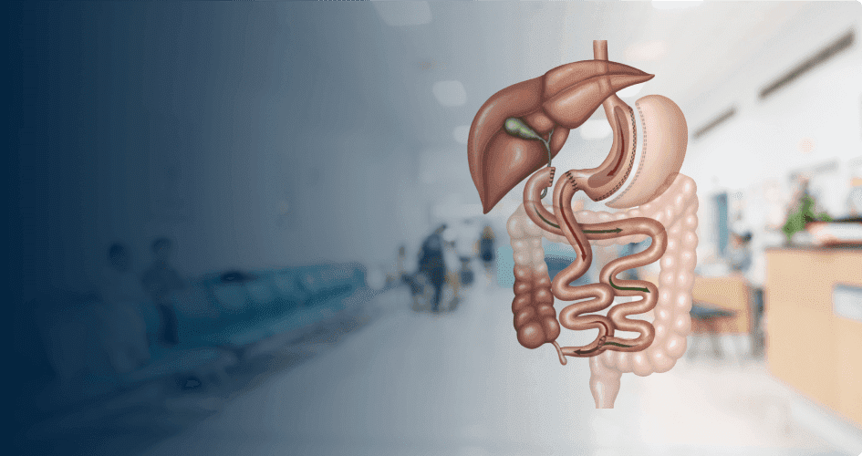 Biliopancreatic Diversion With Duodenal Switch