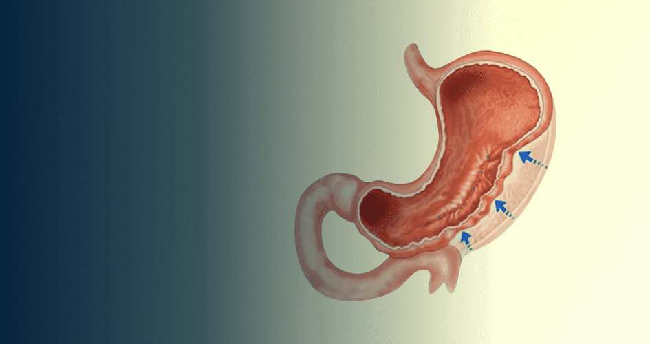 Endoscopic Sleeve Gastroplasty