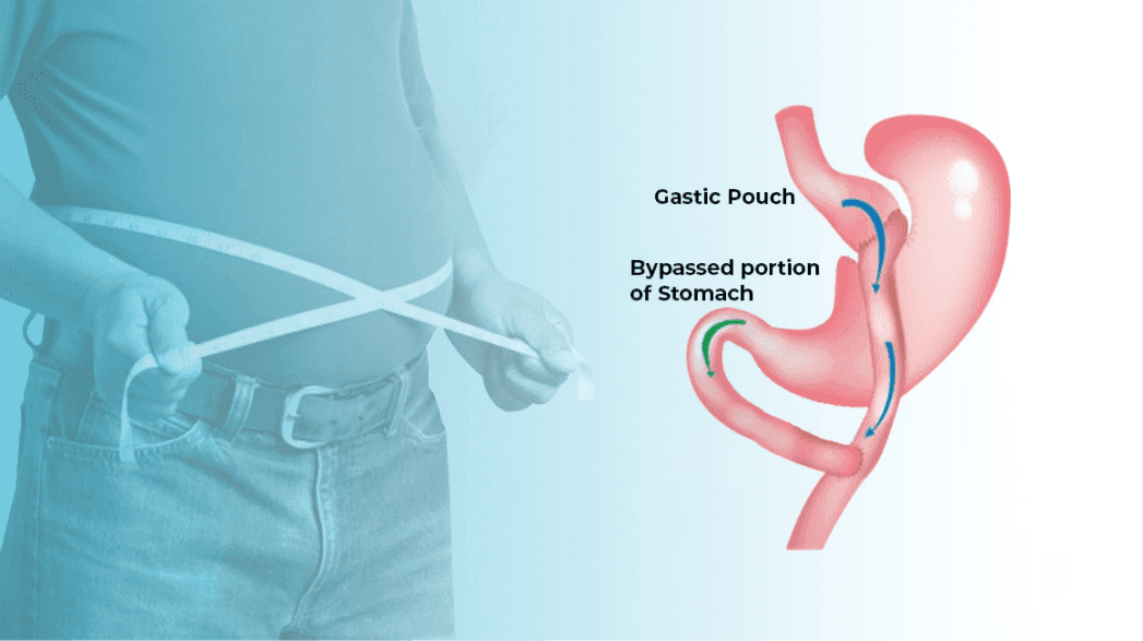 Gastric Bypass Surgery
