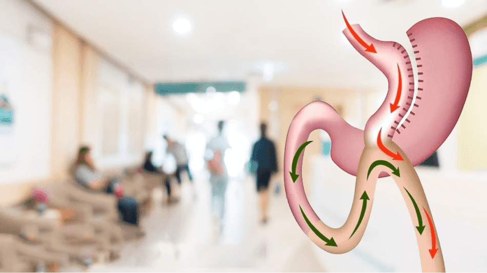 Mini Gastric Bypass
