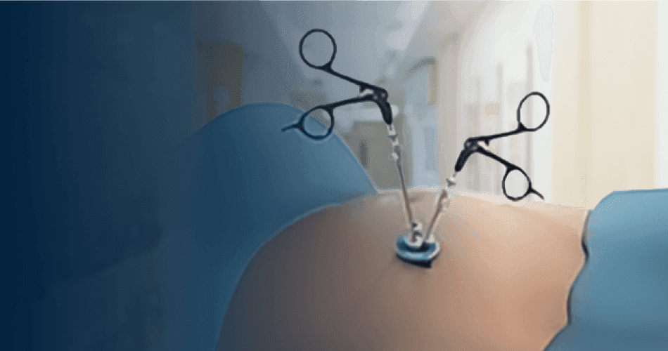 Single Port Bariatric Surgeries
