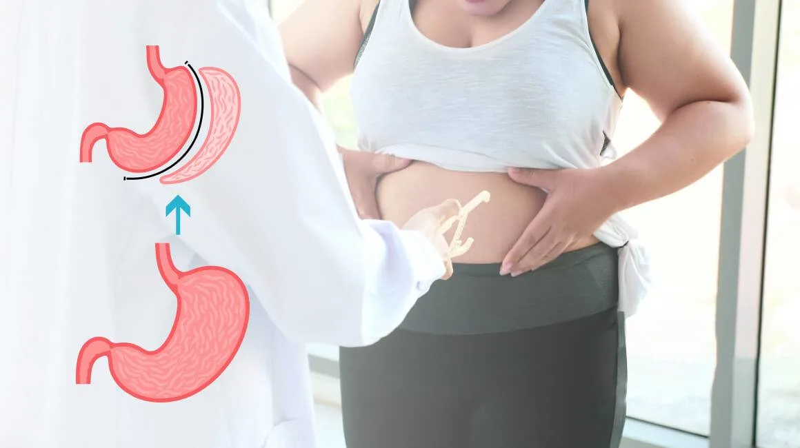 Bariatric Surgery